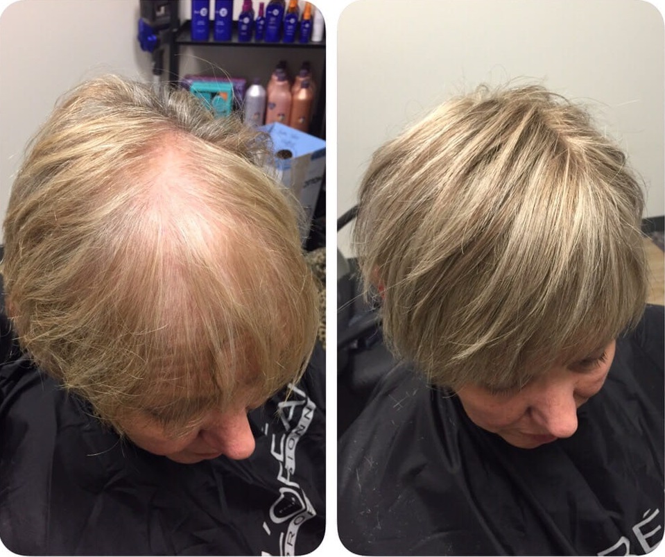 before and after hair thinning new 2